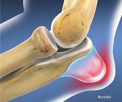 Common Causes Of Pain Behind The Elbow: Olecranon Bursitis aka Student's Elbow. Causes, symptoms, diagnosis & treatment