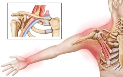 Thoracic Outlet Syndrome often causes shoulder pain radiating down arm Thoracic Outlet Syndrome often causes shoulder pain radiating down arm