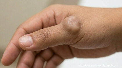 Lump And Pain In Thumb: Ganglion Cyst. Find out about the causes, symptoms and treatment of ganglion cyst lumps in the thumb