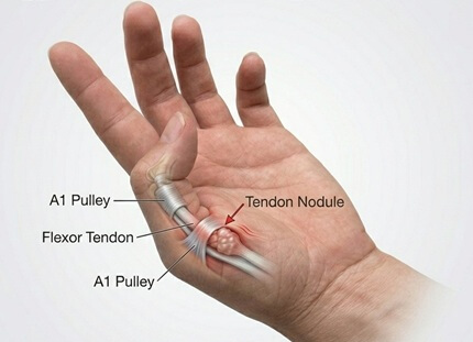Thumb Pain Causes: Trigger Thumb. Causes, symptoms, diagnosis and treatment