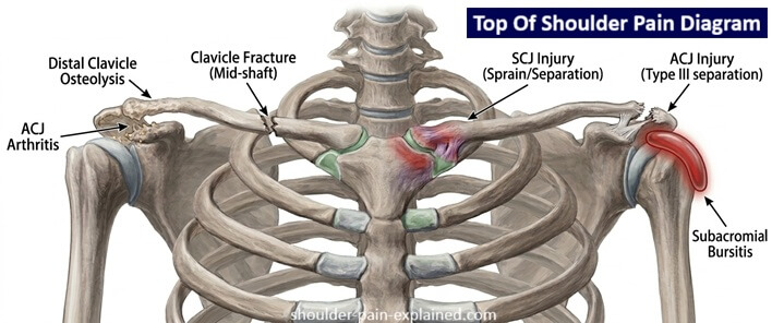 Top Of Shoulder Pain Diagnosis: Common causes include rotator cuff tears, collarbone injuries, shoulder impingement syndrome and sub acromial bursitis.