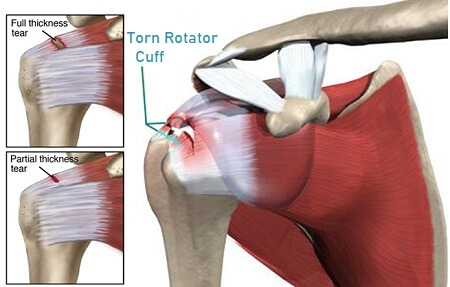 Torn Rotator Cuff Symptoms And Treatment - Shoulder Pain Explained