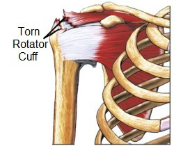 Torn Rotator Cuff Symptoms And Treatment - Shoulder Pain Explained