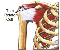 Rotator cuff tear shop rehabilitation