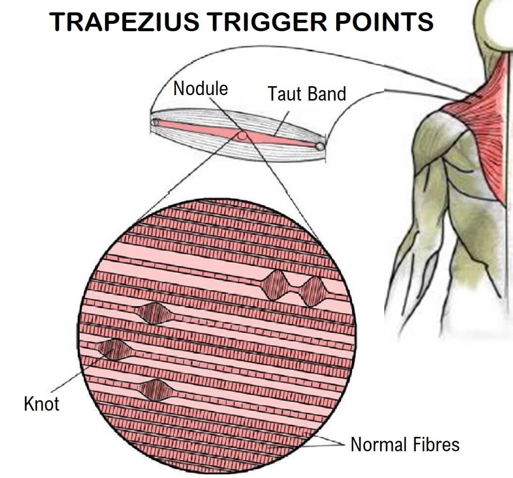 Shoulder muscle knots or trigger pointsBeware Its A Trap