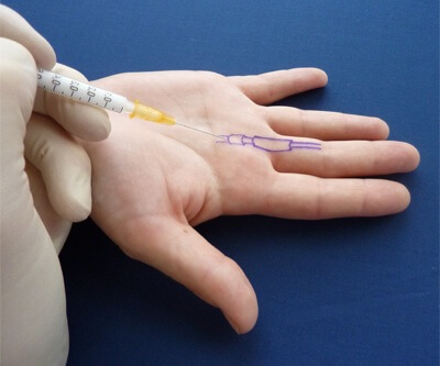Trigger Finger Injection: How to treat trigger finger with steroid injections