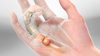 Trigger Finger Lump Inside Palm Of Hand: Common causes, symptoms, diagnosis and treatment