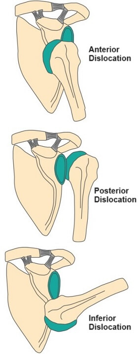Types Of Shoulder Dislocation: Anterior shoulder dislocation, posterior shoulder dislocation, inferior shoulder dislocation.
