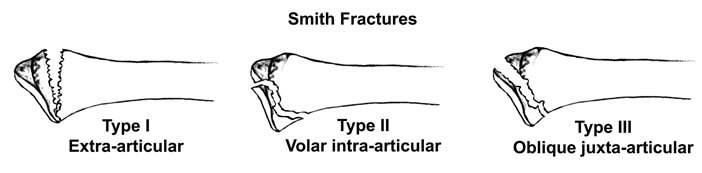 Types of Smith Fracture, distal radius