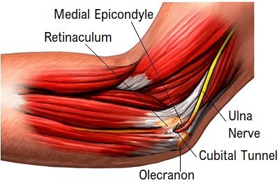 Ulnar Nerve Neuropathy - Symptoms, Risks & Treatments