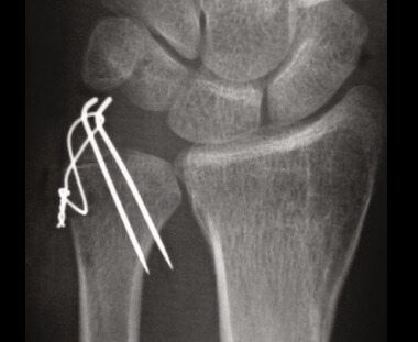 Ulnar Styloid Fracture Treatment: ORIF surgery for broken ulnar styloid