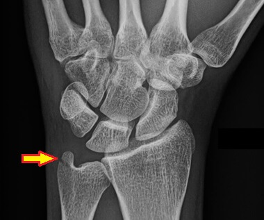 Wrist pain diagnosis: Ulnar Styloid Fractures cause inner wrist pain. Find out about the symptoms, causes and treatment Wrist pain diagnosis: Ulnar Styloid Fractures cause inner wrist pain. Find out about the symptoms, causes and treatment