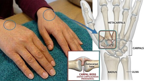 What Is A Carpal Boss? A carpal boss wrist is a hard lump that forms near the back of the wrist joint. Find out about causes, symptoms, diagnosis and treatment. What Is A Carpal Boss? A carpal boss wrist is a hard lump that forms near the back of the wrist joint. Find out about causes, symptoms, diagnosis and treatment.