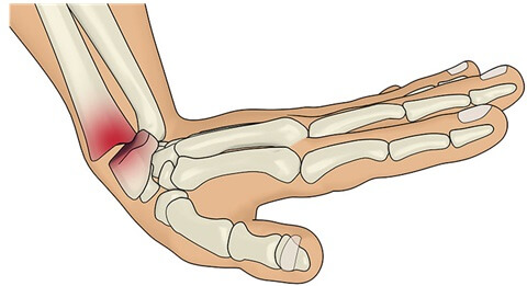 What Is A Colles Fracture? A Colles fracture is a common wrist fracture affecting the distal radius. Find out about the common causes, symptoms and treatment options