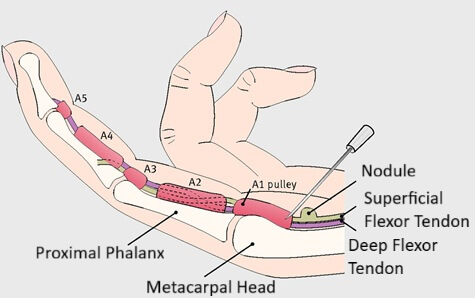 What Is Trigger Finger? Causes, symptoms, diagnosis, treatment and prevention