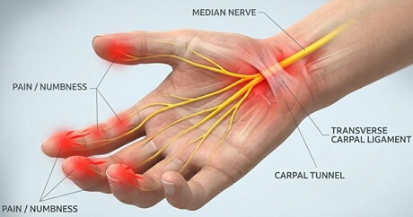 Wrist and Finger Pain: Carpal Tunnel Syndrome causes pain, tingling and numbness in the fingers. Find out about causes, symptoms and treatment options