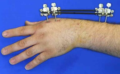 Distal Radius Fracture External Fixation Surgery