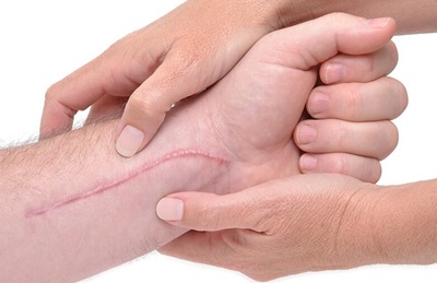 Distal Radius Fracture Surgery Scar Massage