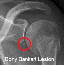 Una lesión ósea de Bankart: donde parte de la fosa glenoidea se rompe durante la dislocación anterior del hombro.