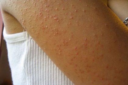 Kelaris Rash Keratosis Pilaris Treatment, Causes & Symptoms