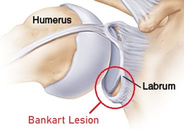 Lesión de Bankart - Desgarro del labrum del hombro.  Causas, síntomas, diagnóstico y tratamiento