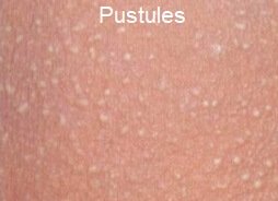 Arm Shoulder Acne Causes Treatment